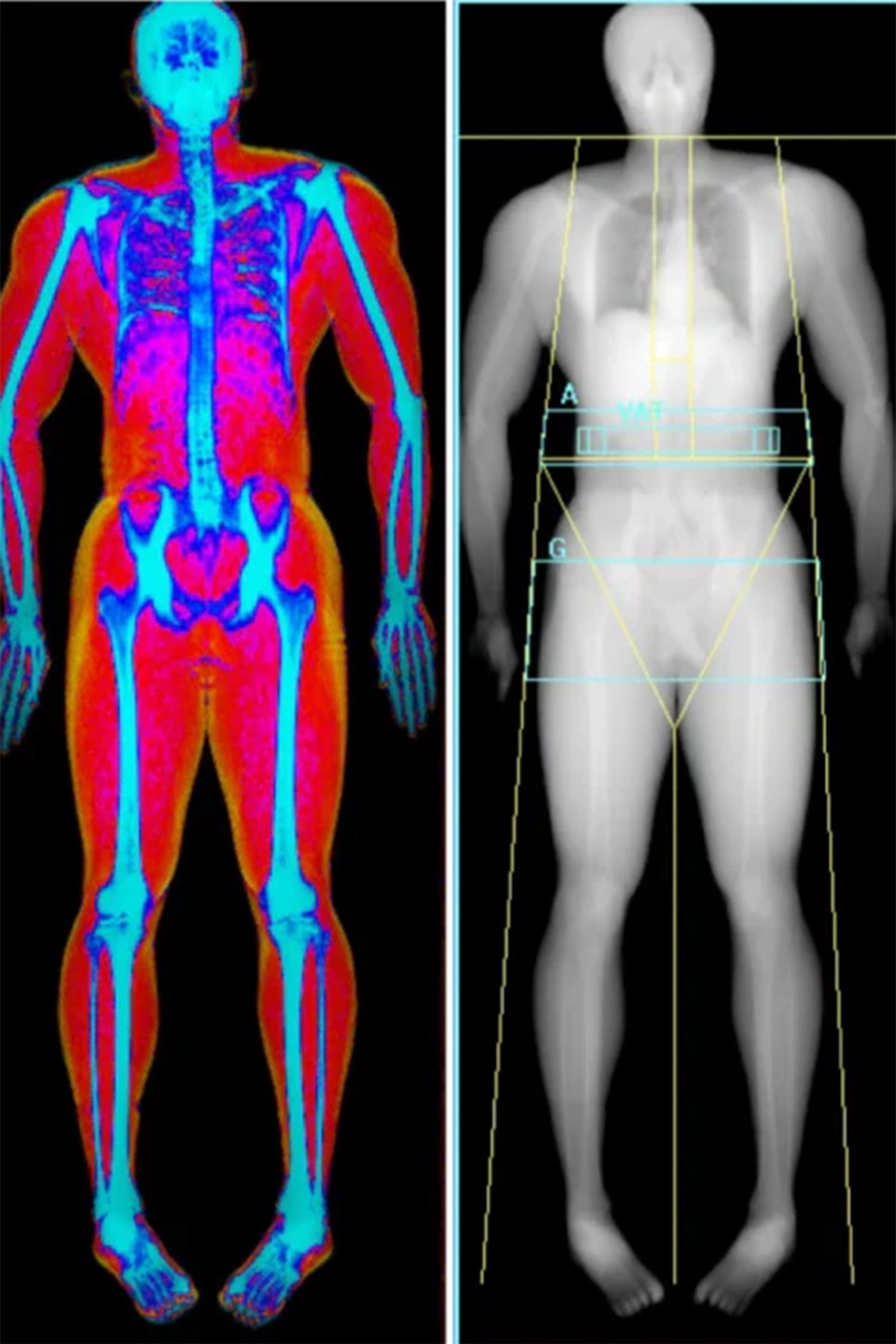 NWW, Dexa Scan, Results